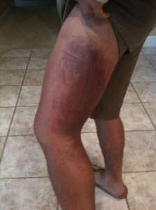 Urijah Faber's leg after taking some devastating leg kicks from Jose Aldo